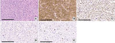 Concurrent IDH1 and IDH2 mutations in glioblastoma: A case report